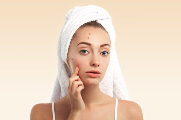 Tinh bột nghệ trị mụn hiệu quả và an toàn tại nhà